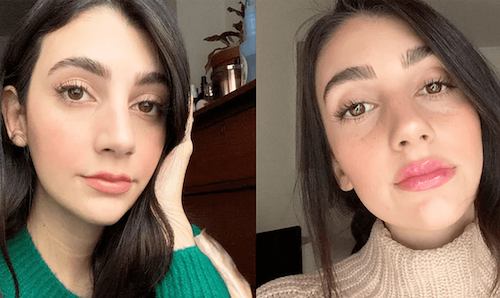 Smooth Lip Contours Before After Mississauga Lip Doctor 1